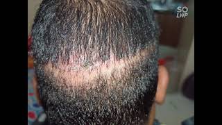Medispadamaged Fut Scar After 6 Months Of Transplant