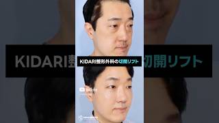 一回の切開リフトでここまで変わる！男性もフェイスリフトで若返りする時代！ #shorts