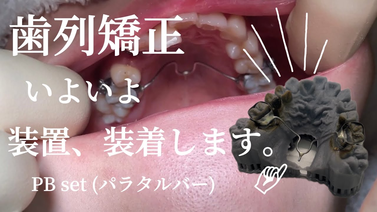 【ワイヤー矯正】装置、装着します！！！