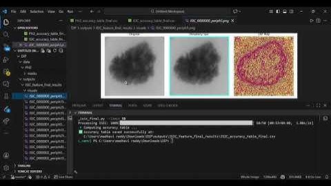 Active Contour–Based Skin Lesion Segmentation & Classification Using GradienBoosting & ExtraTrees