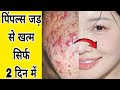 पिंपल्स, मुंहासे दाग धब्बे से हमेशा के लिए छुटकारा पाए Pimple removal on face at home #skincare #diy