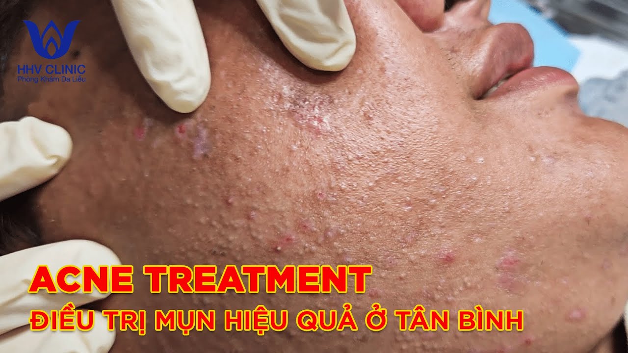 HHV Clinic | dothuhien | hienvanspa acnetreatment & điều trị mụn hiệu quả ở tân bình|Van Duan-Pa