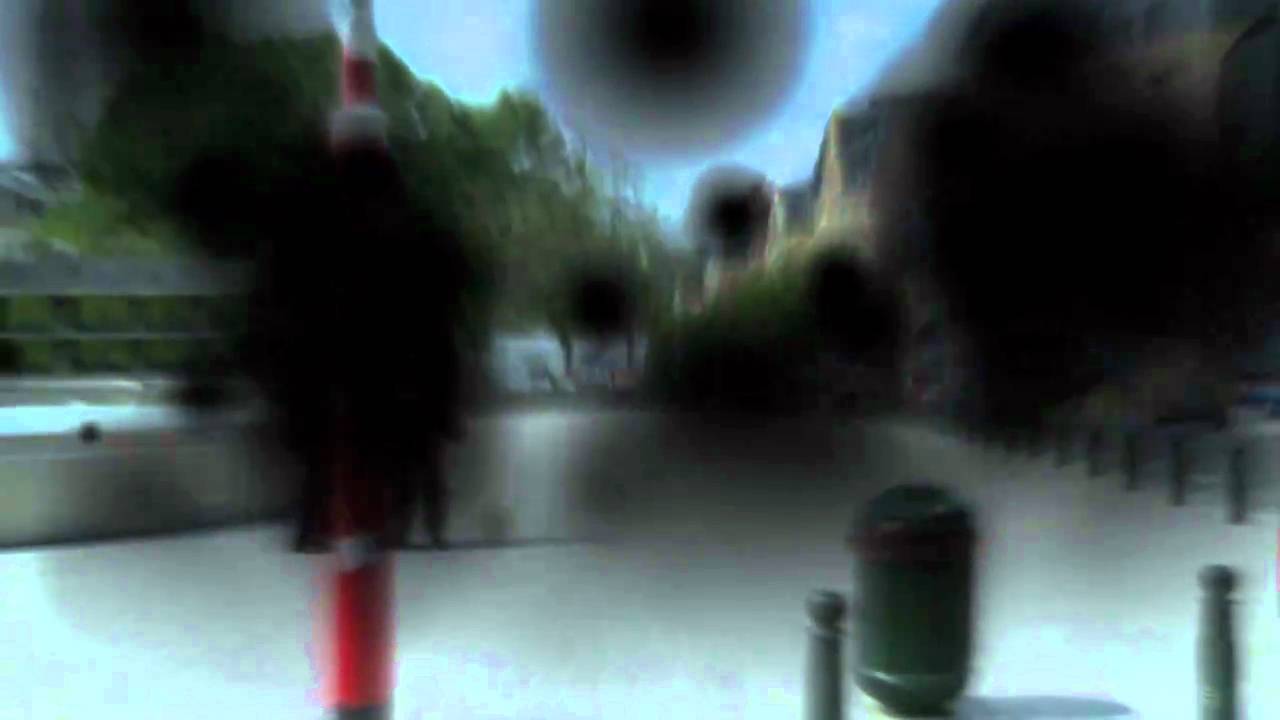 Glasvochtbloeding bij proliferatieve diabetische retinopathie - YouTube