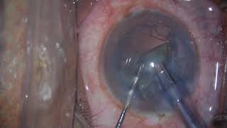 COLLAGE OF SOFT CATARACTS ( BY DR SUSHIL KAKHANDKI) screenshot 2