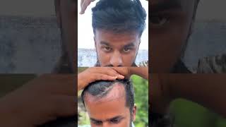 Ak Hair Transplant Results @Chennai, Velachery. Proof is in the progress! 🚀, Contact - 72000 99924.