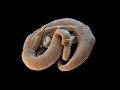 Schistosomiasis Part 3 (Chapter 16)