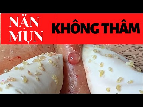 CÁCH NẶN MỤN Không bị THÂM  sản phẩm trị thâm mụn HẾT  NHANH NHẤT CỦA CHUYÊN GIA TRỊ MỤN