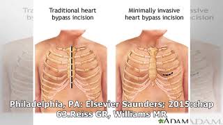 Aortic valve surgery - minimally invasive: MedlinePlus Medical Encyclopedia