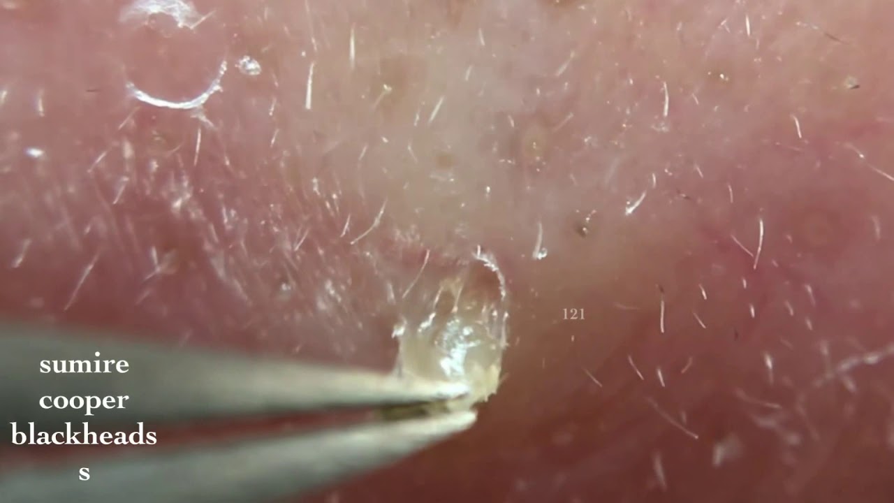 鼻角栓121 2nose Blackheads Larger Version Tweezerz Only Youtube