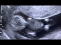 Sonogram  singleton pregnancy at 11 weeks