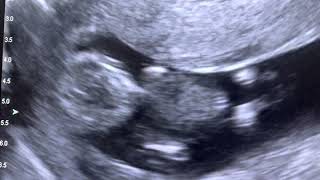 Sonogram:  Singleton Pregnancy at 11 weeks