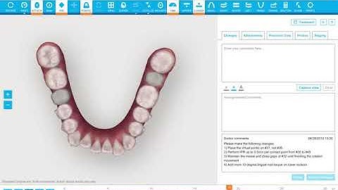 INVISALIGN ĐIỀU TRỊ RĂNG CHEN CHÚC VÀ CẮN CHÉO RĂNG CỬA