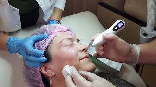 34 PLASMA PEN (ПЛАЗМА ПЕН) ОБУЧЕНИЕ МОСКВА - Курс ведет Врач дерматолог-косметолог Хуснутдинова Н.В. 34 PLASMA PEN (ПЛАЗМА ПЕН) ОБУЧЕНИЕ МОСКВА - Курс ведет Врач дерматолог-косметолог Хуснутдинова Н.В.