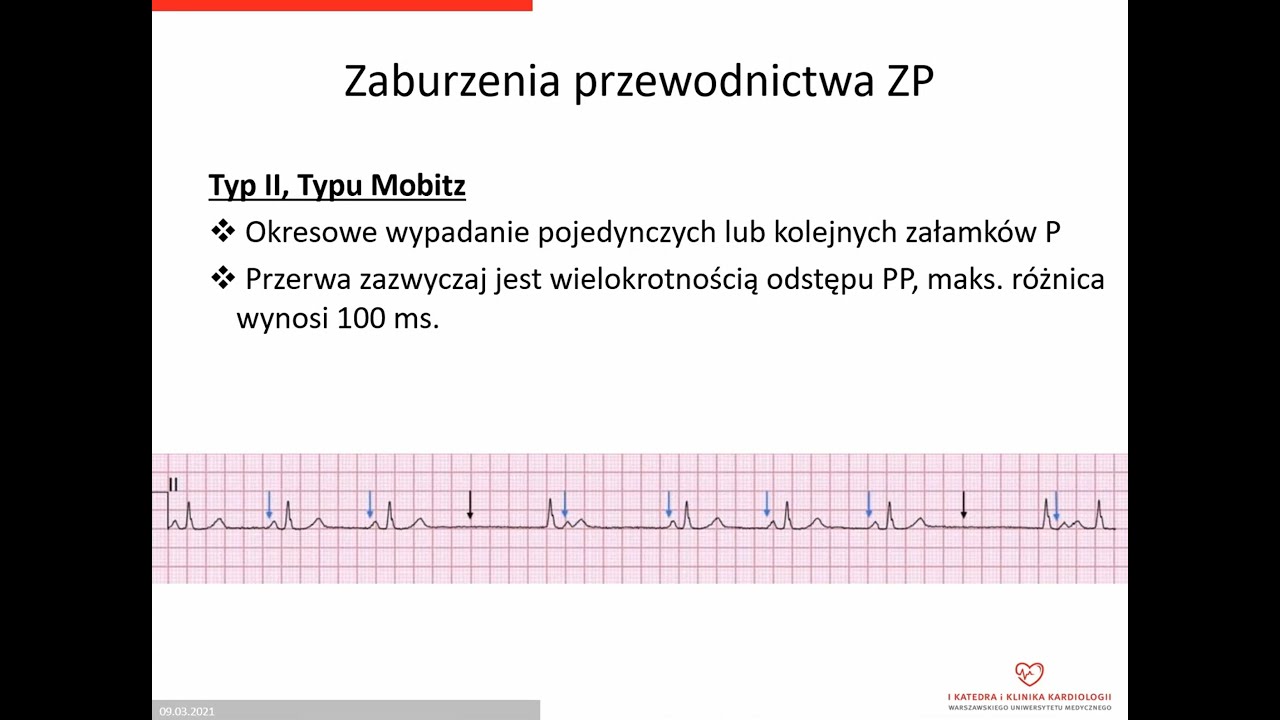 Warsztaty EKG Kurs Podstawowy 3 Bloki Przedsionkowo komorowe warsztaty-ekg-kurs-podstawowy-3-bloki-przedsionkowo-komorowe