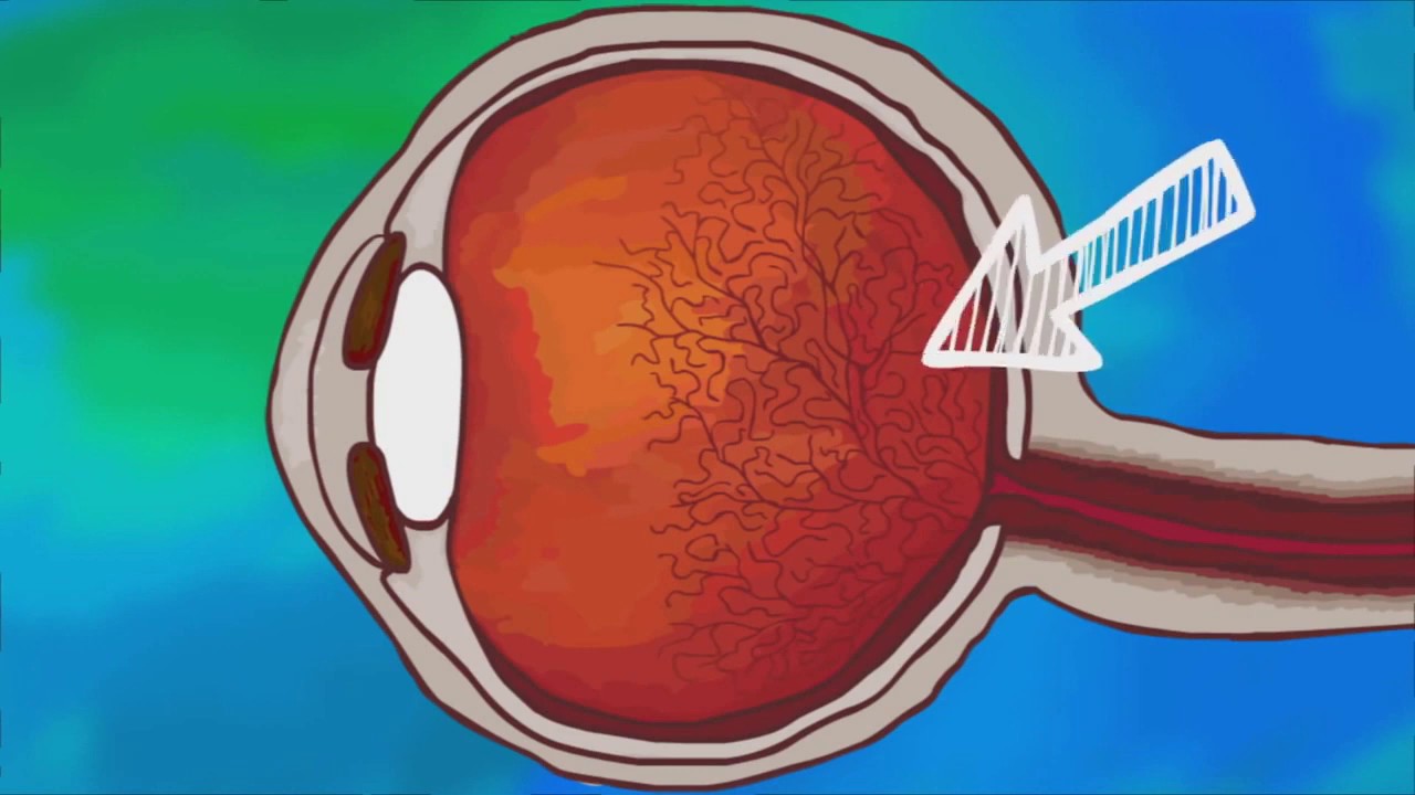 Что за мушки плавают перед глазами? - YouTube