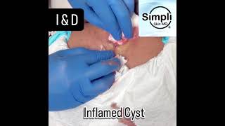 Inflamed Cyst Incision Drainage