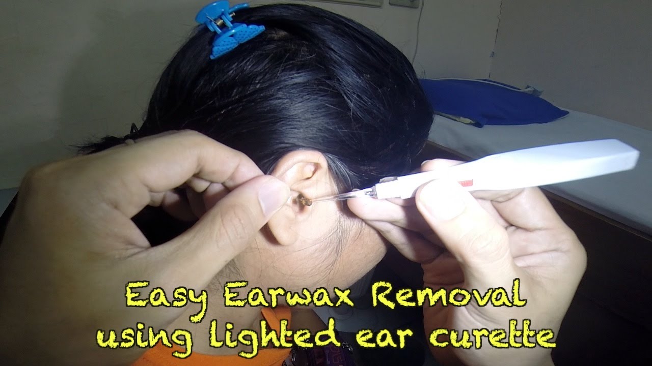 Easy Earwax Removal using lighted ear curette - YouTube