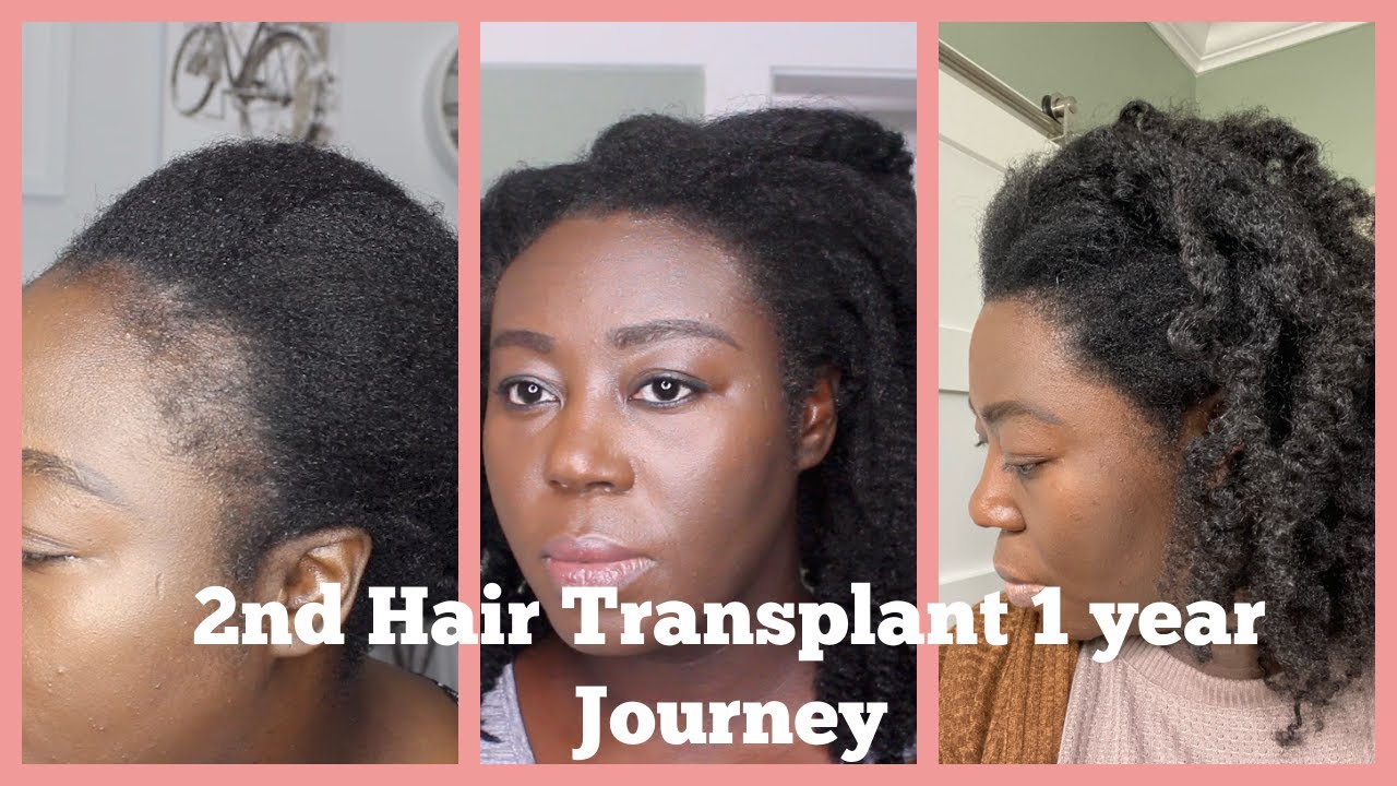 My 2nd Hair Transplant 1Year Journey