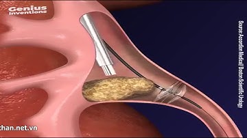 CÁC PHƯƠNG PHÁP LẤY SỎI THẬN-TTUT.TS.BS. DUONG VĂN TRUNG- TEL 0913534343.WEB: soithan.net.vn