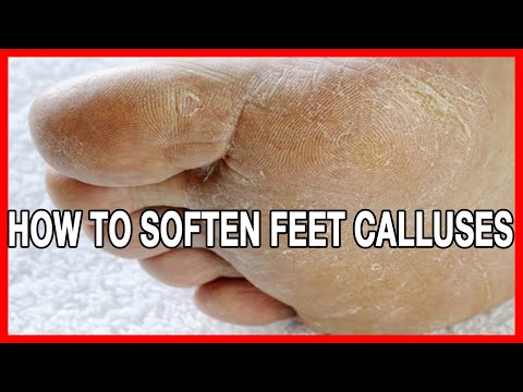 How To Soften Feet Calluses // Home Remedies