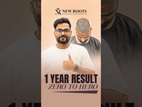 Hair Transplant in Lucknow | 1 Year Result | Grade 5 Baldness #hairgrowth #shorts