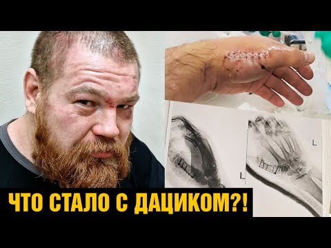 Что стало с Дациком?!  Дацик про травму после Шульского и бой против Кавалари