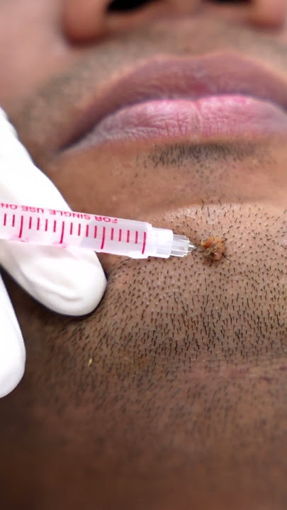 Wart Removal | SKIN WARTS | Skin Wart Removal #shortvideo #shots