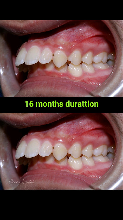 Kawat gigi untuk gigi tonggos, 16 bulan #kawatgigi #doktergigi #perawatangigi #doktergigi