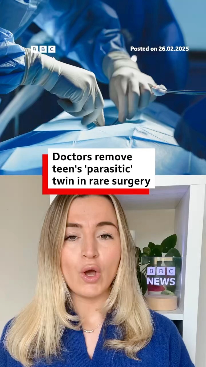 Doctors in India remove a teenager’s ‘parasitic’ twin in rare surgery. #BBCNews