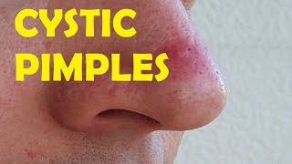 how to get rid of cystic pimples on nose