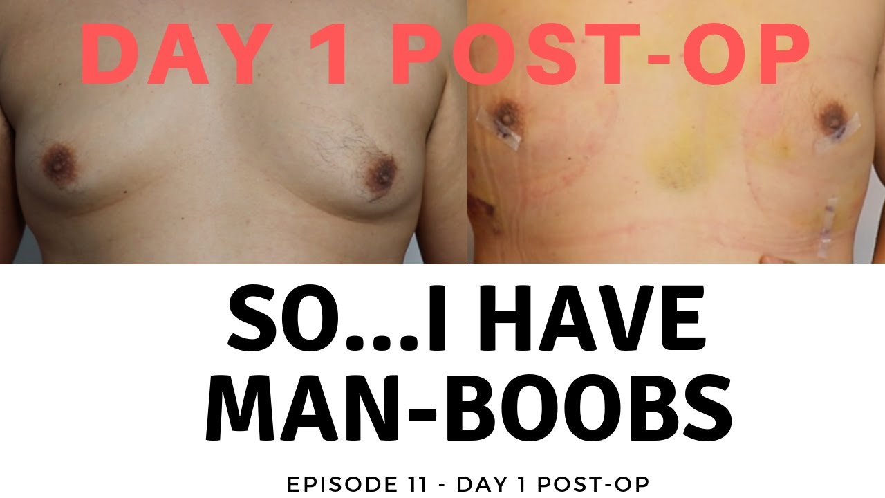 Day 1 Post Op Gynecomastia Surgery | So I Have Man Boobs | Gynecomastia | Episode 11