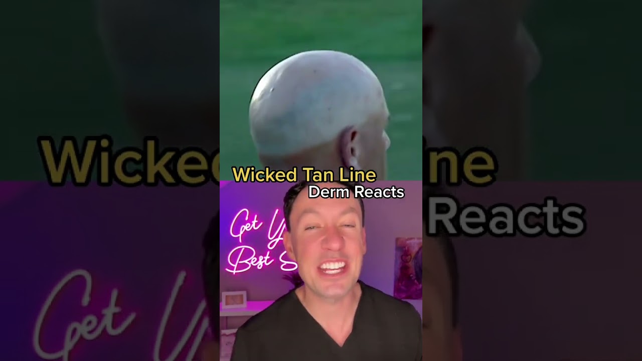 Дерматолог отреагировал на БЕЗУМНУЮ полосу загара 
