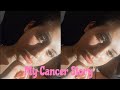 Osteosarcoma | My Cancer Story