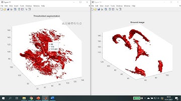 White Matter Hyperintensities segmentation