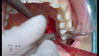 The harvesting of free gingival graft