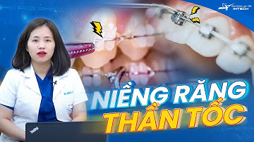Thời Gian Niềng Răng Là Bao Lâu | Các Yếu Tố Quyết Định Thời Gian Chỉnh Nha Của Bạn