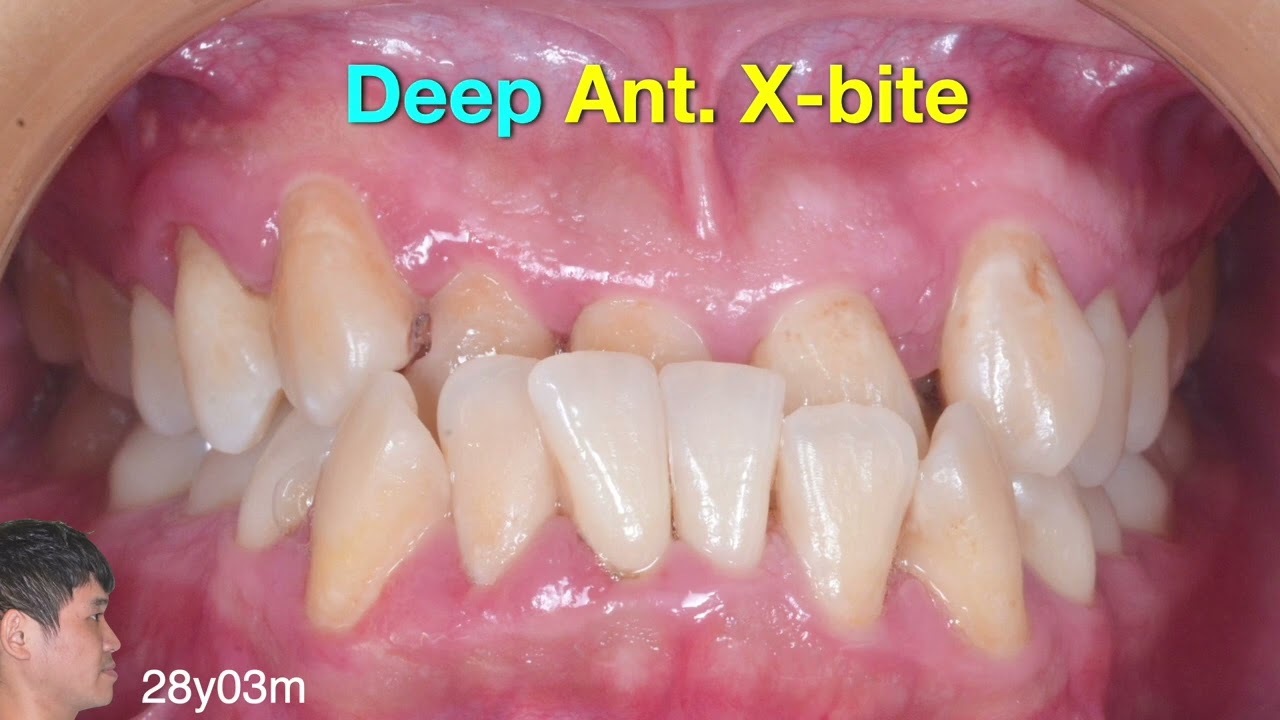 Pre-Aligner Treatment for Class III Anterior Crossbite Correction｜【Chris Chang Ortho】CC695