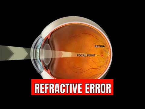 Refractive error Of