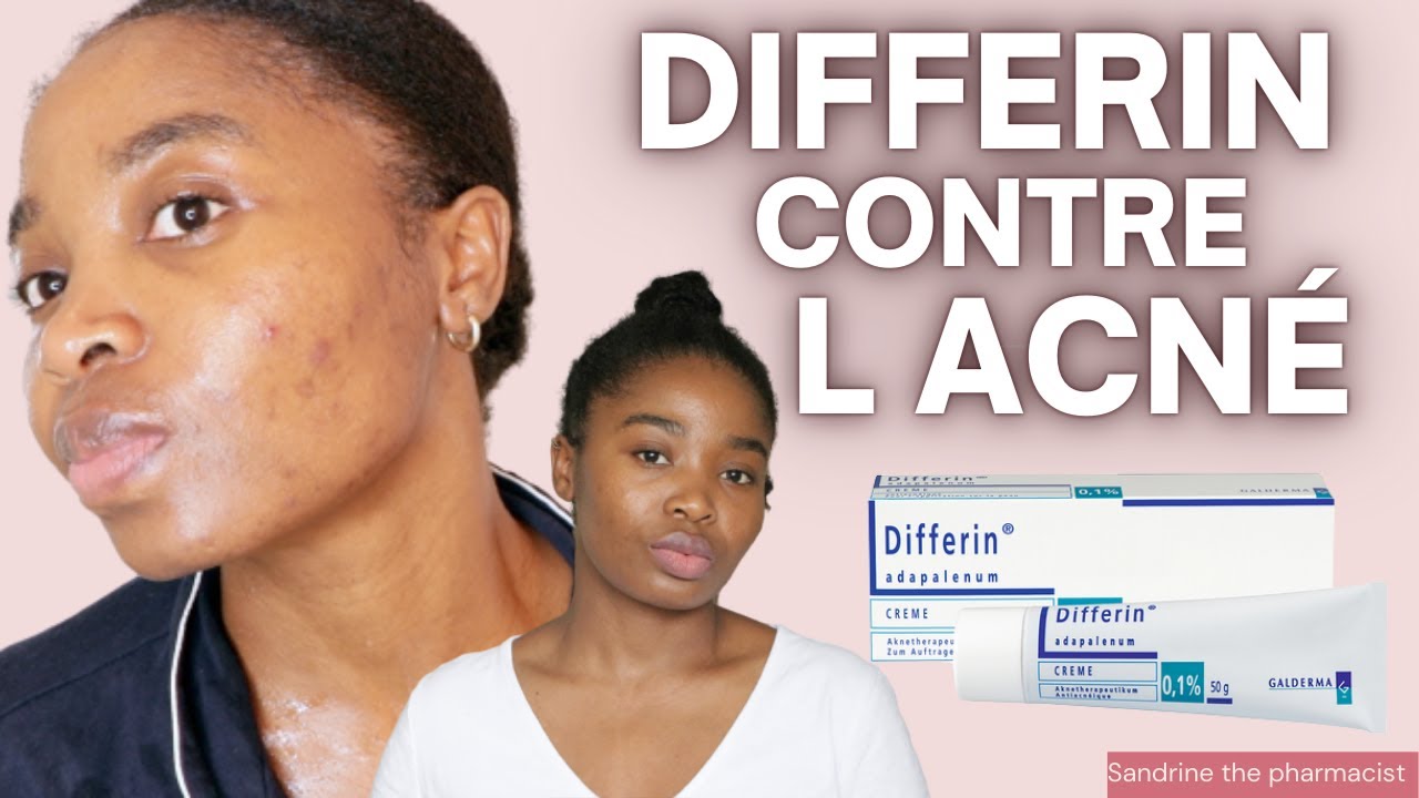 COMMENT TRAITER SON ACNE RAPIDEMENT AVEC DIFFERIN ET S EN DEBARRASSER