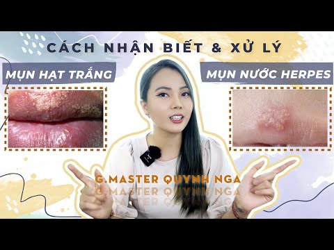 Môi Bé Có Màu Trắng - Mụn hạt trắng Fordyce ở môi: Cách nhận biết, nguyên nhân và xử lý