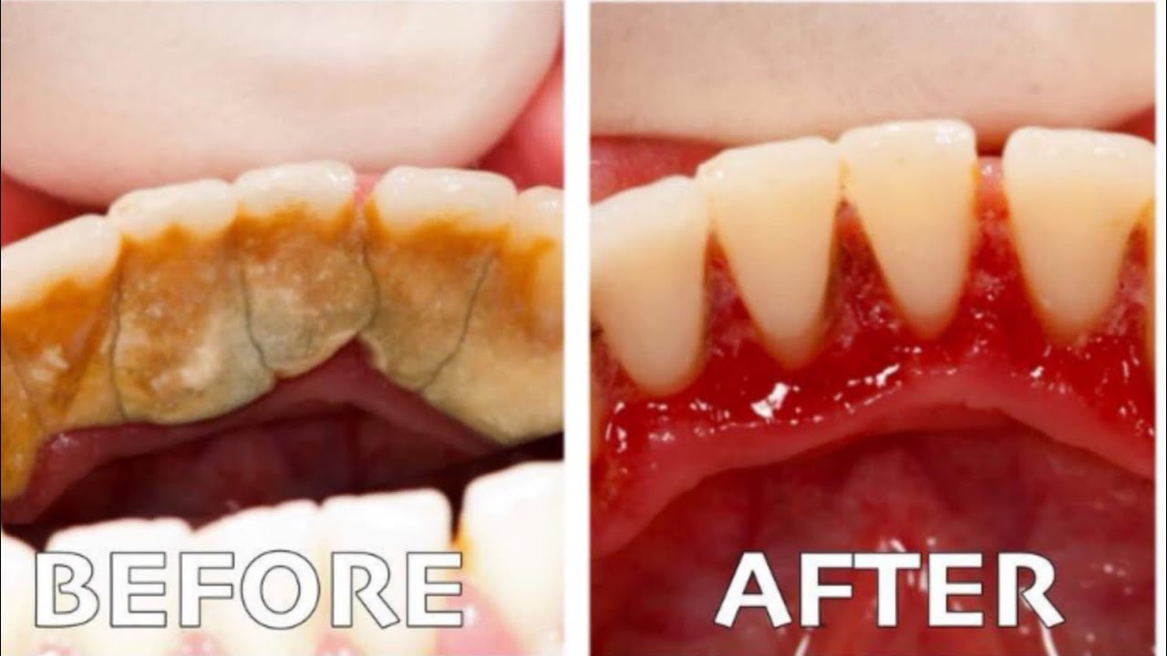 Remove Dental Plaque In 2 Minutes With Home RemedySmi Health And