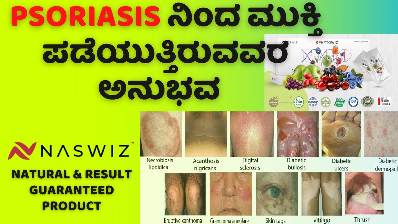 Psoriasis Reducing day by day Phytowiz result testimony Kannada
