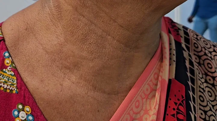 Dancing carotids, Corrigan’s sign