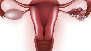 Dismenorrea: Desorden premenstrual (SPM, DDPM) - Dra. Indira Centeno