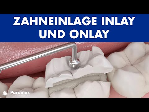 Video: Was ist ein Zahninlay?