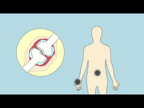 Video: Seropositieve Reumatoïde Artritis: Behandeling, Symptomen En Prognose