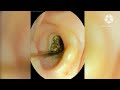 "2 Saal Ka Jamaa Hua Mayel Dekh Kar Hairaan Reh Jaoge! 😱 Ear Cleaning Video#EarCleaning #Satisfying