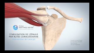 STABILISATION DE L'ÉPAULE PAR BUTÉE CORACOÏDIENNE (INTERVENTION DE LATARJET) - DR MATTHIEU MEYER