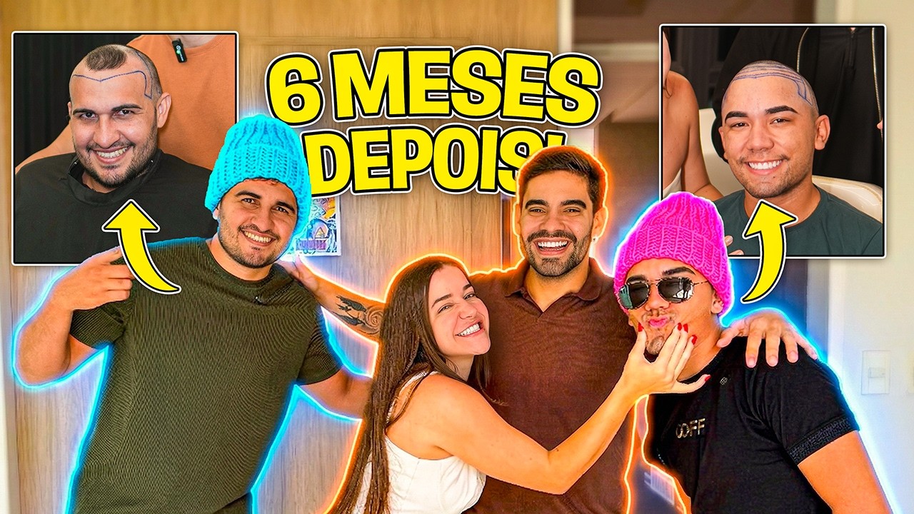 Resultado de 6 meses do IMPLANTE capilar!