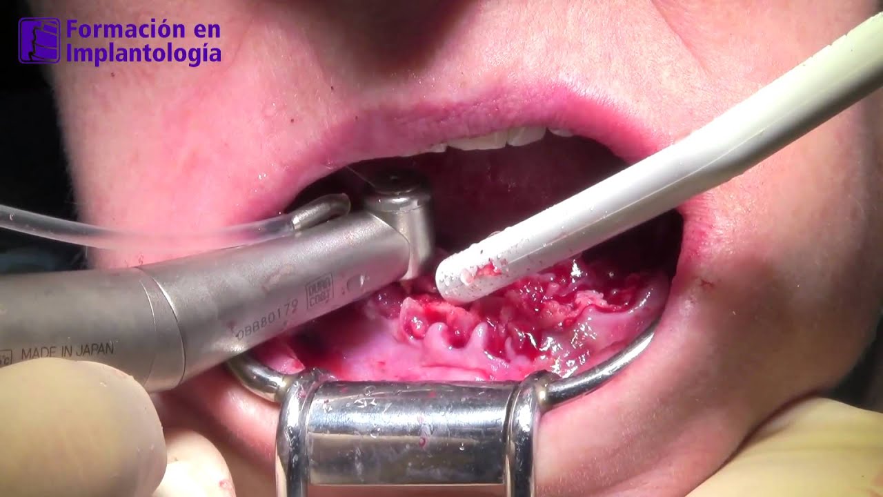 Cuanto Cuesta Un Injerto De Hueso Dental Formación en Implantología- Implantes dentales con injerto de hueso